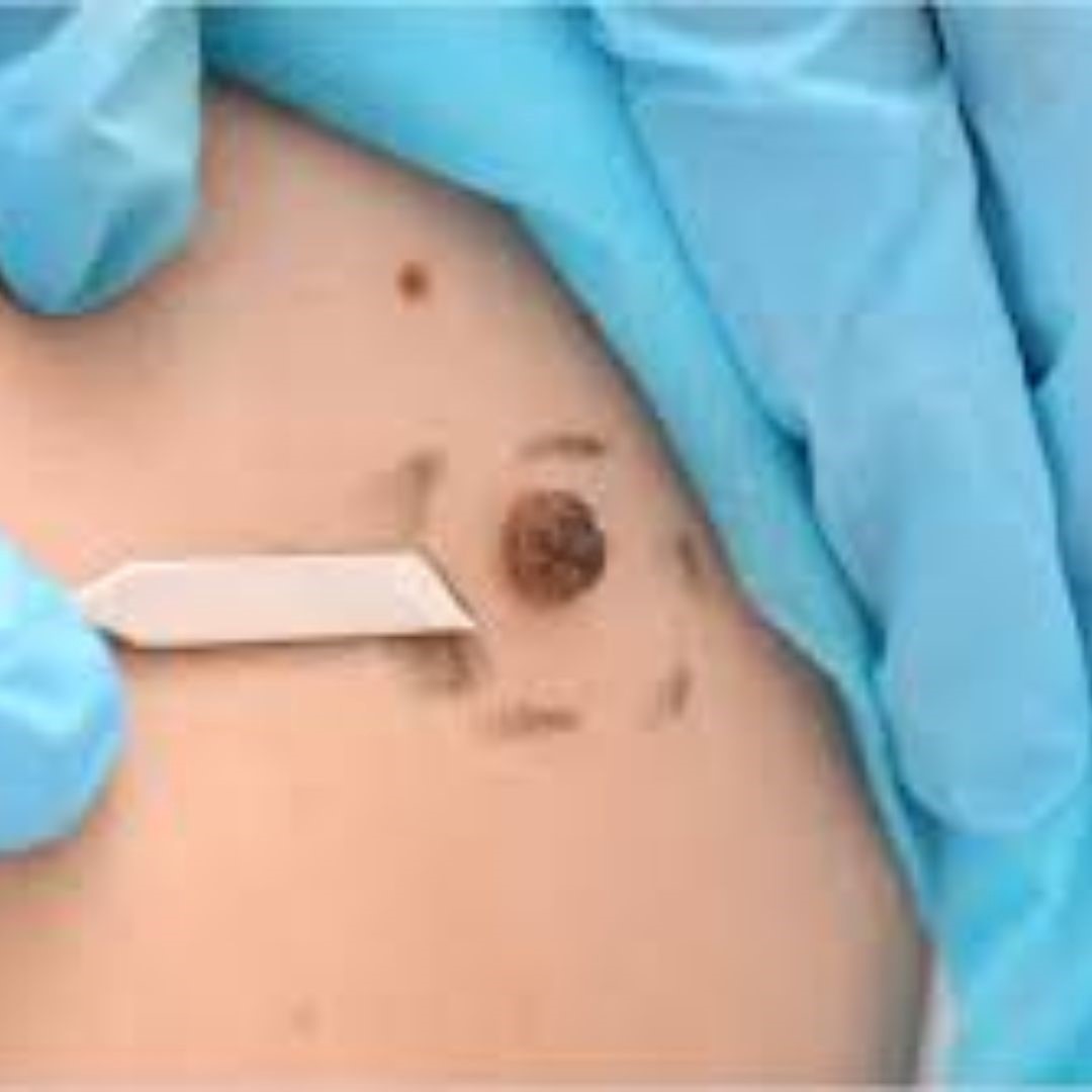 Face Skin Tag Removal: Effective Methods and Solutions - Lotology