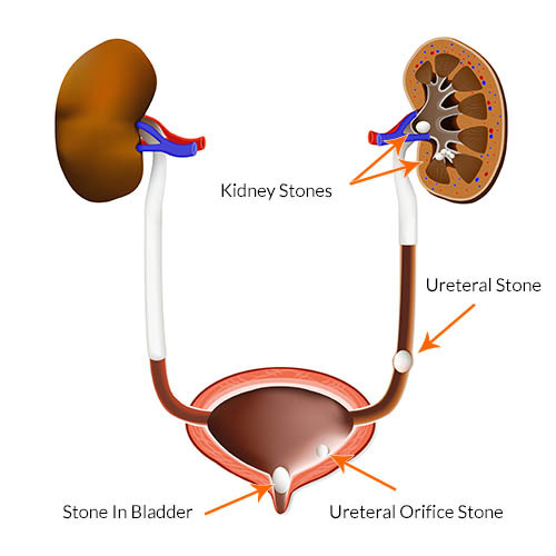 Understanding Kidney Stones – @tasknetworkx on Tumblr