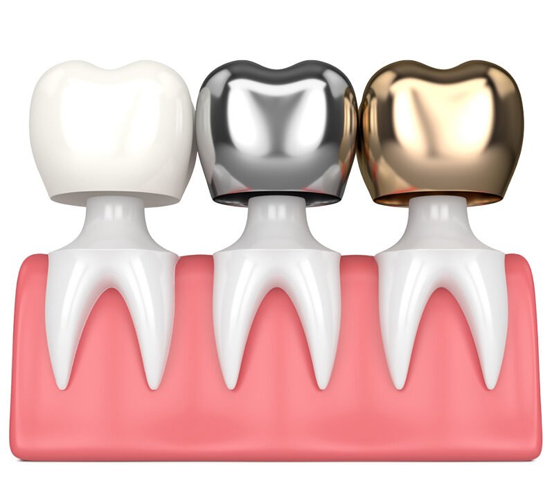 Dental Crowns in Abu Dhabi City | Affordable Solutions