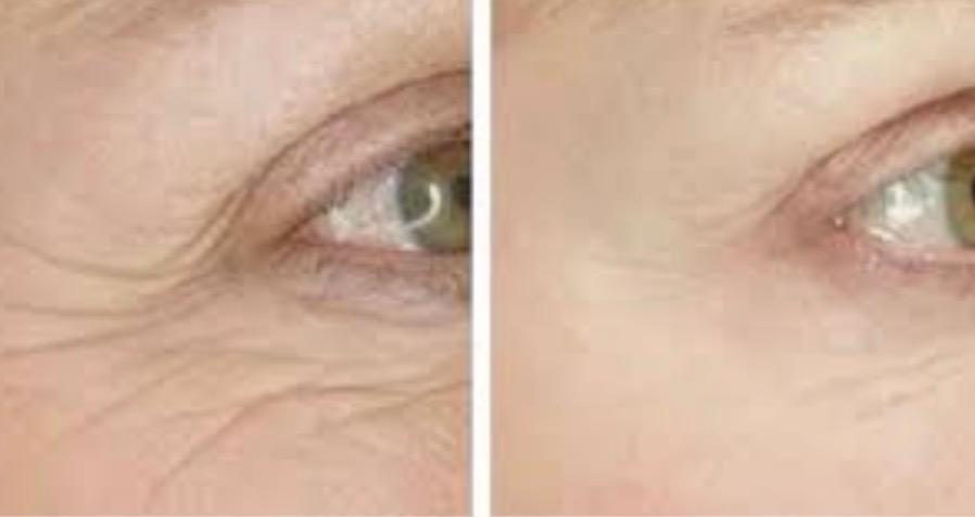 Laser Wrinkle Therapy London | Smooth & Youthful Skin