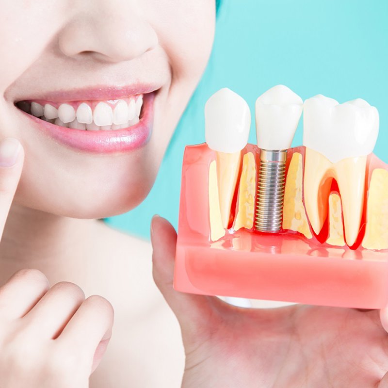 Best Dental Implants in Abu Dhabi | Restore Your Smile