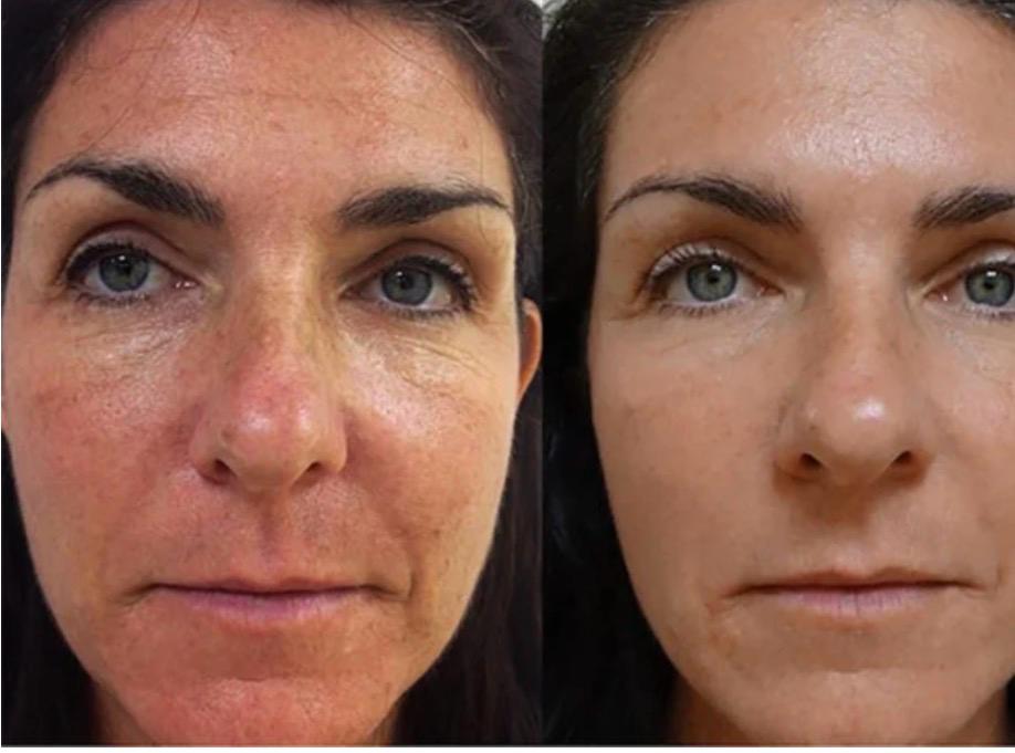 Laser Skin Resurfacing London | Renew & Smooth Skin