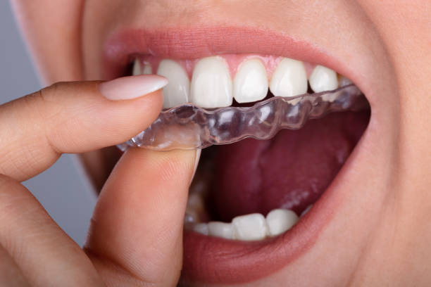 The Role of Clear Aligners in the Evolution of Contemporary Orthodontics | Pair Orthodontics