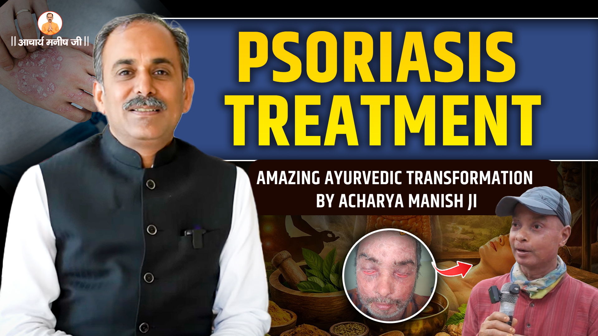 Best Ayurvedic Psoriasis Treatment | Acharya Manish Ji